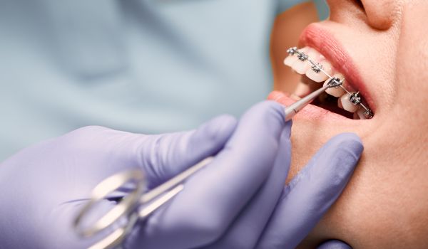 orthodontist hands placing braces on a woman's teeth