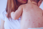 A mother in the Netherlands taking care of her infant with measles