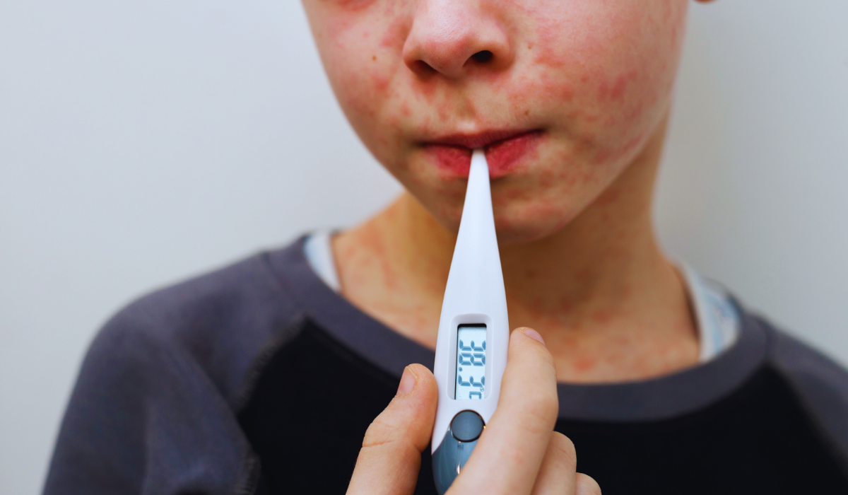 A child with measles in the Netherlands