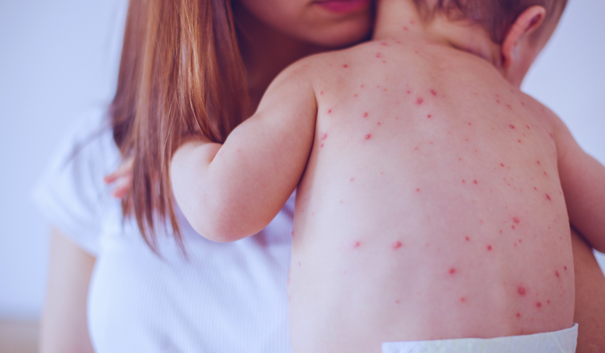 A mother in the Netherlands taking care of her infant with measles